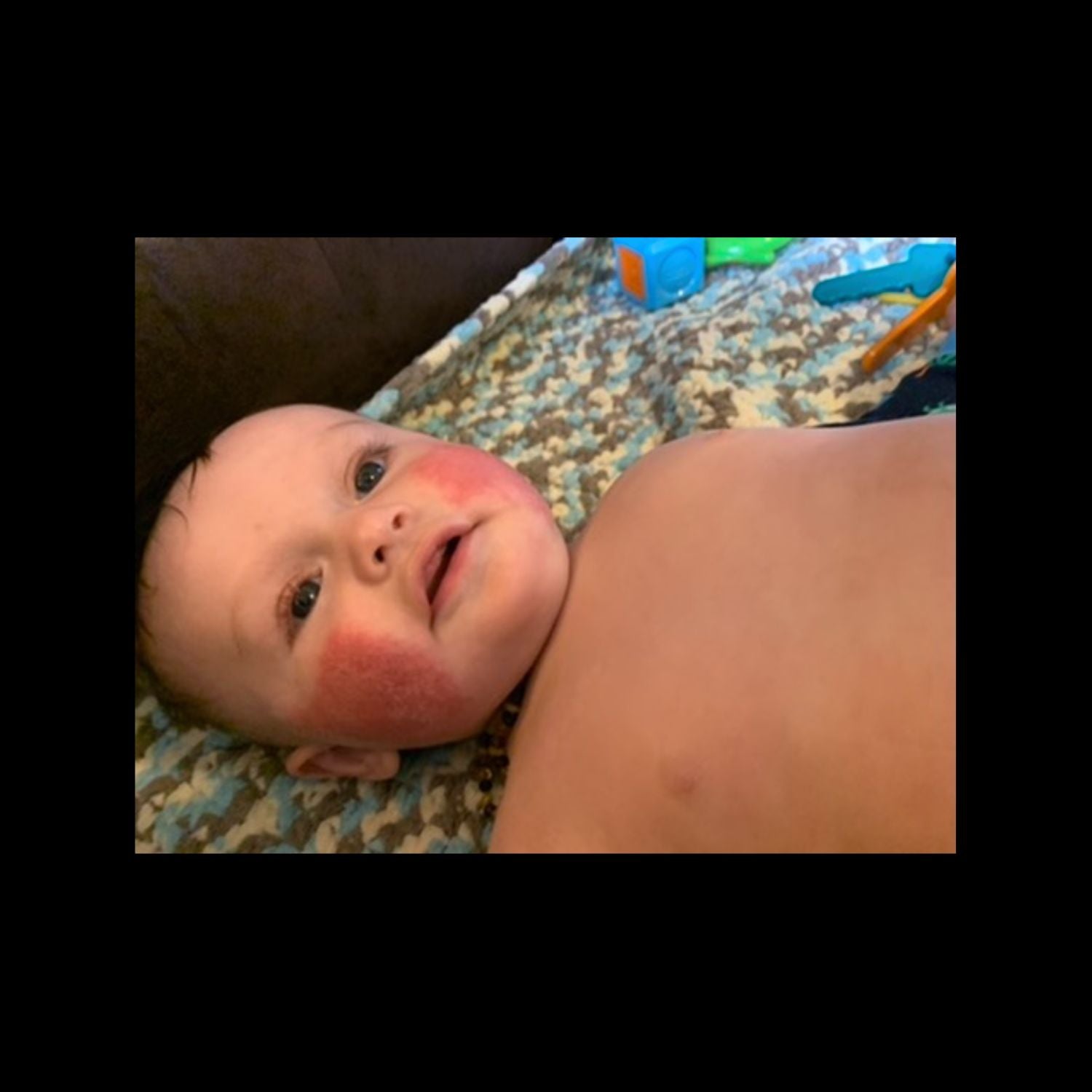 Eczema breakout1
